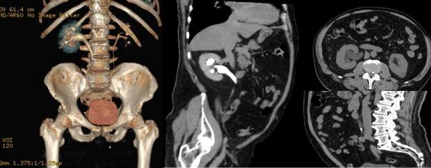 urografia prin tomografie computerizată investigație gratuită la spitalul victor babes din timisoara